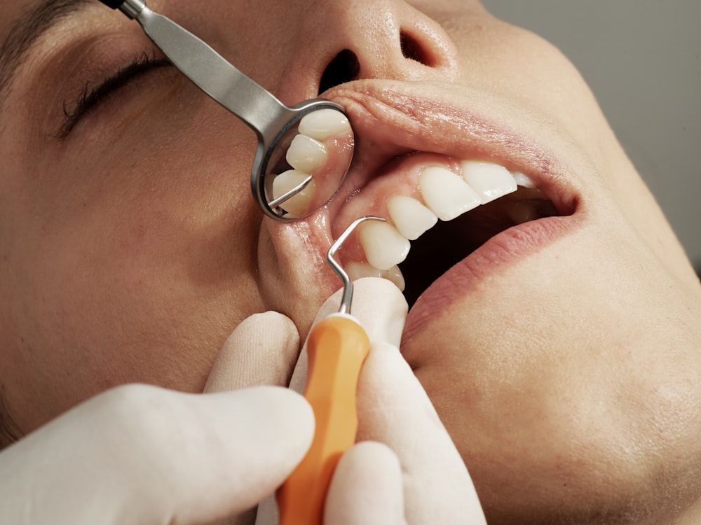 Preventive Sealants